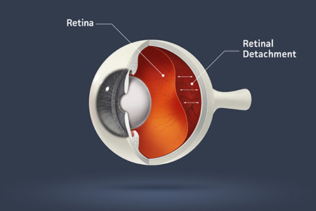What are the symptoms of a torn retina?