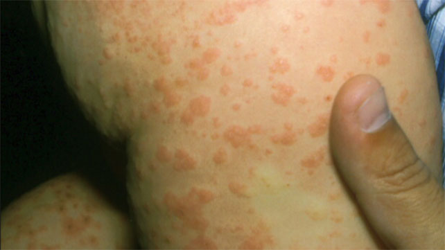 What Is Acrodermatitis ? Causes, Symptoms, and More