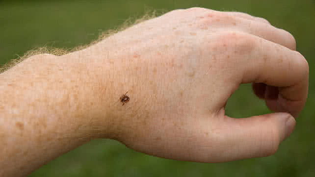 When should a tick bite be treated by a doctor?