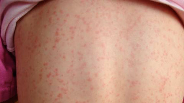 Picture of Bacterial Diseases and Problems – Scarlet Fever