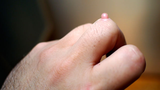 How to Get Rid of Warts on Hands - noskinproblems.com