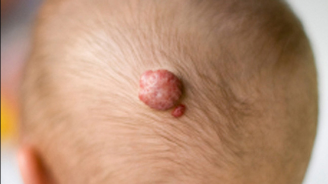 What Causes Skin Tags ? | Acrochordon - Live Science
