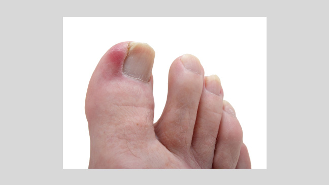 raised toe nails #10