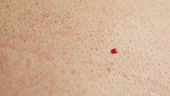 Cherry Angioma Identification Causes And Treatments 