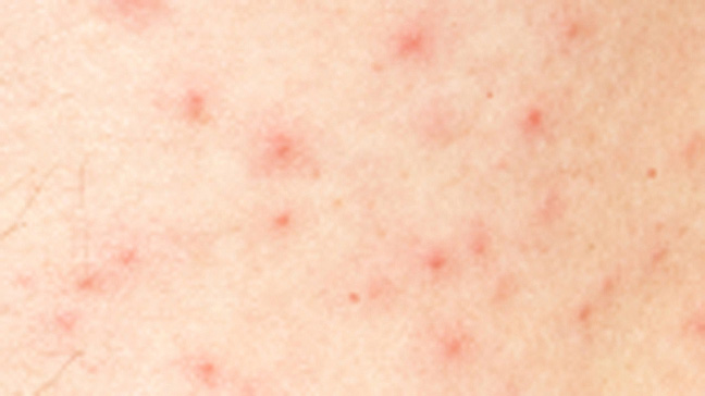 Doctor insights on: Chicken Pox Like Rash On Legs - HealthTap