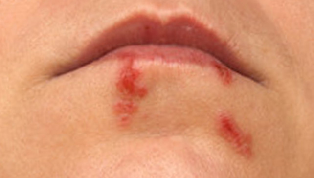 cold sore on chin pictures #11