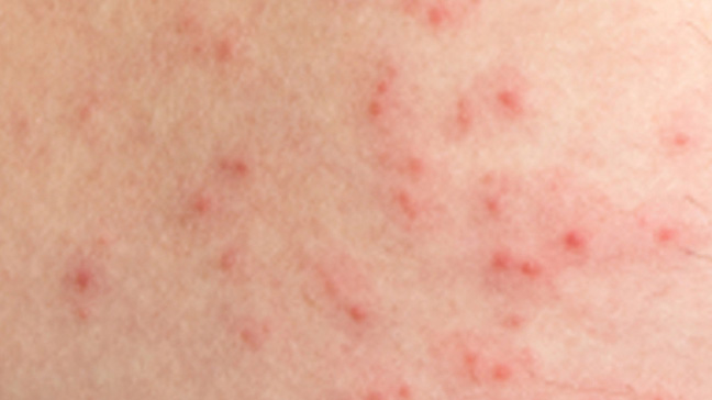 Scabies Guide: Causes, Symptoms and Treatment Options