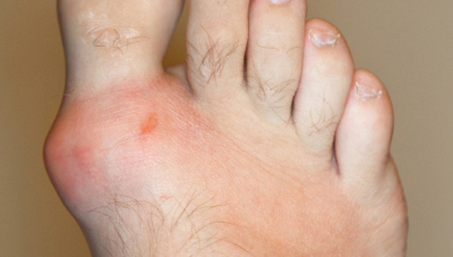 Foot Joints Affected By Gout gout symptoms
