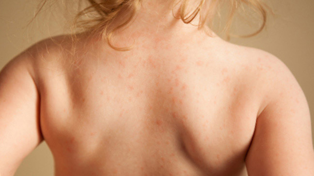 Newborn and baby rashes: Eczema, acne, & other skin ...