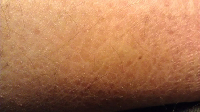 When a tiny patch of scaly skin is the first sign of ...