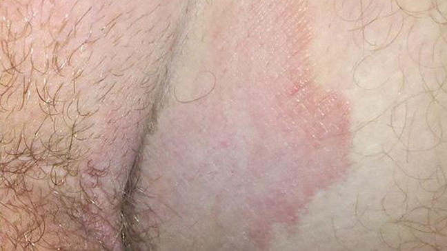 Folliculitis - Pictures, Symptoms, Treatment and Prevention