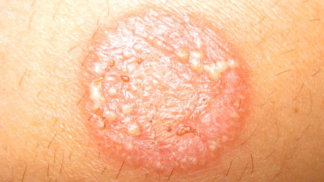Round itchy rash - Dermatology - MedHelp