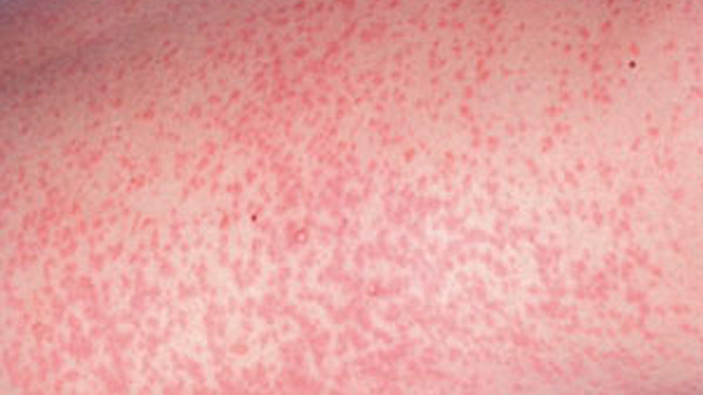 Measles Rash - Pictures, Symptoms ... - Diseases Pictures