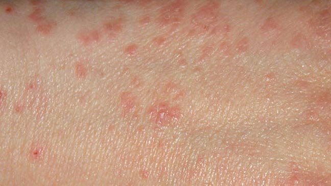 About Scabies - Pictures of Scabies on Legs & Body - Verywell