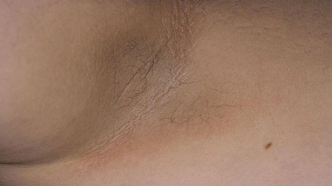 Acanthosis nigricans - Wikipedia