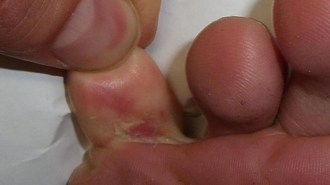 Athlete's Foot: Fungal Infection and Athlete's Foot Symptoms