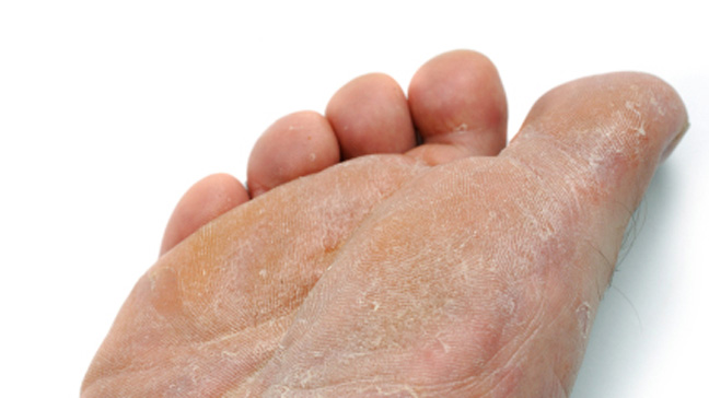 peeling skin between toes #11