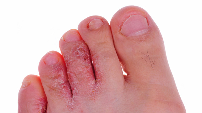 images of athletes foot