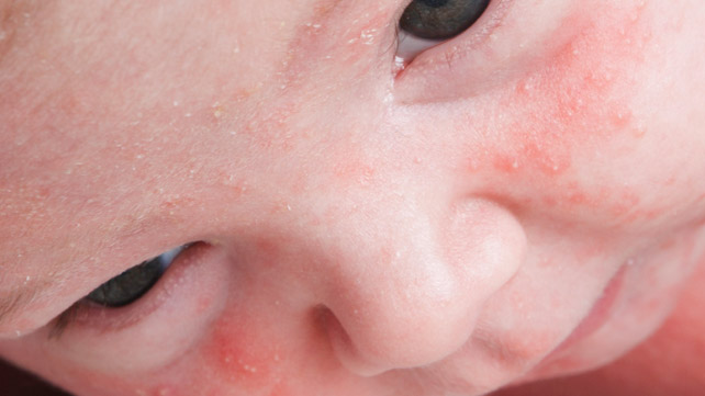 How do you treat baby acne?
