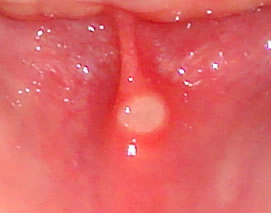 Blood Blister in Mouth - Buzzle