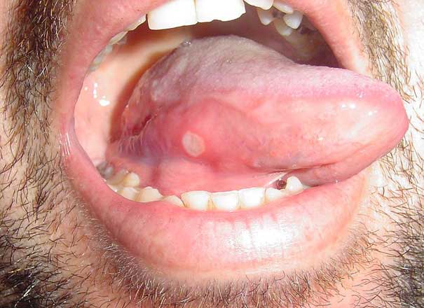 Canker Sore Pictures | Overview of Canker Sores and Treatment