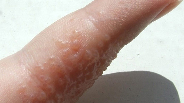 How can you get rid of sores between your toes?