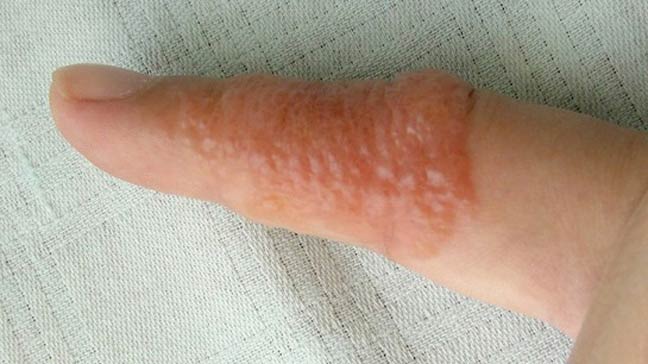 Eczema On Fingers | Adult Eczema