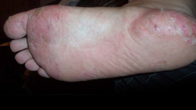 small white bumps on feet | Skin Conditions discussions ...