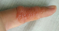 dyshidrotic eczema finger #9
