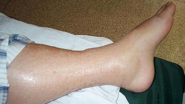 What Would Cause Swelling In Your Legs And Feet 121