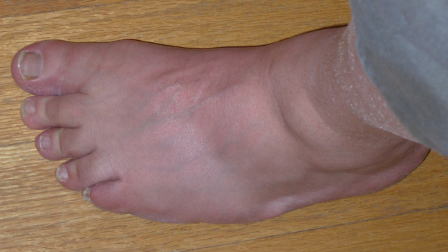 graphic gout pictures gout effect on ankle
