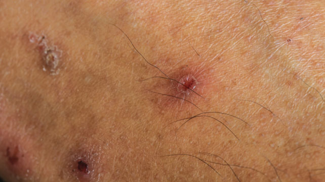 Common Adult Skin-Problem Pictures: Identify Rashes ...