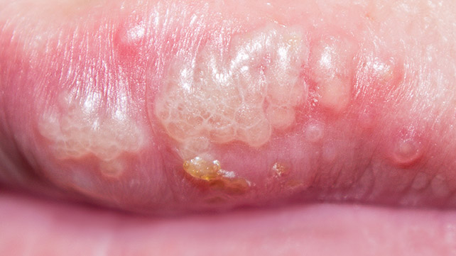 Is the treatment for mouth warts painful?
