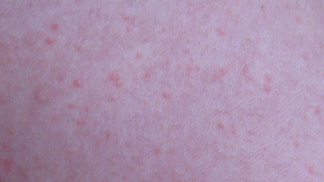 Heat Rash : Get the Facts About Treatment and Symptoms