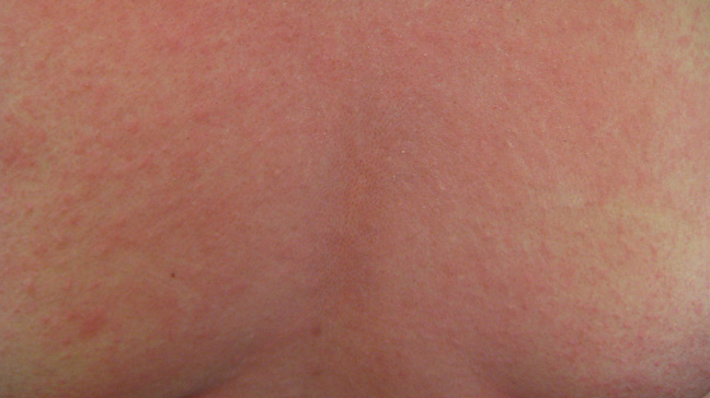 What is a menopause rash?