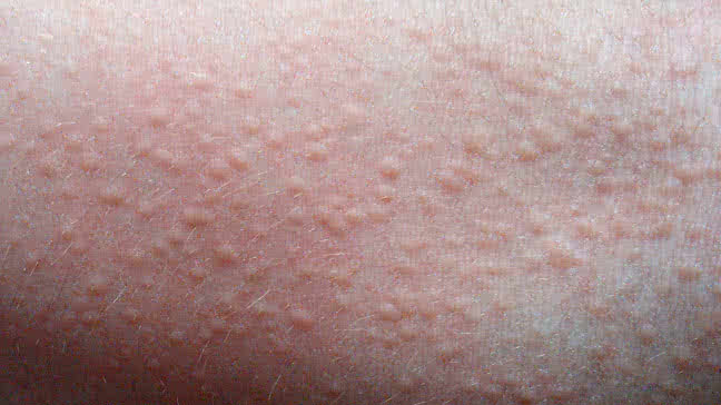 Look for Your Rash in These Rash Pictures - Verywell