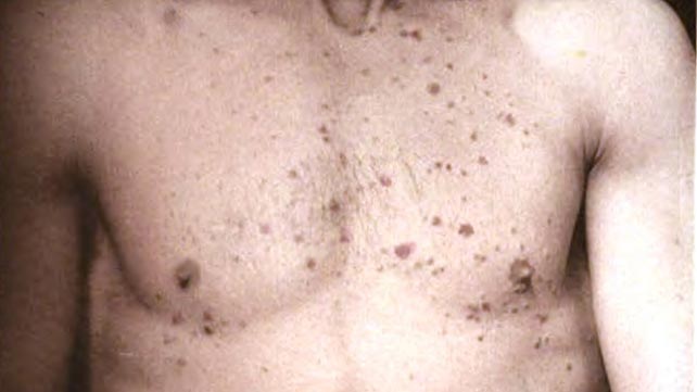 Lichen Planus – Pictures , Symptoms, Causes, Treatment