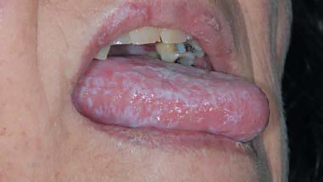 oral lichen planus cause #10