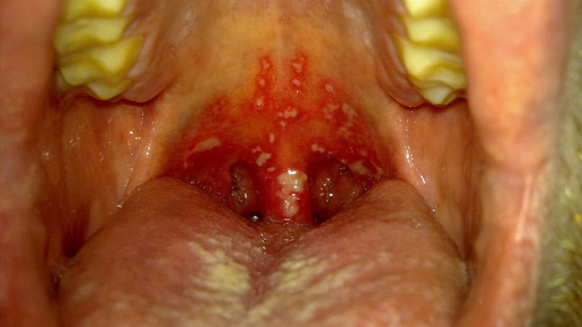Blisters In Back Of Mouth 121