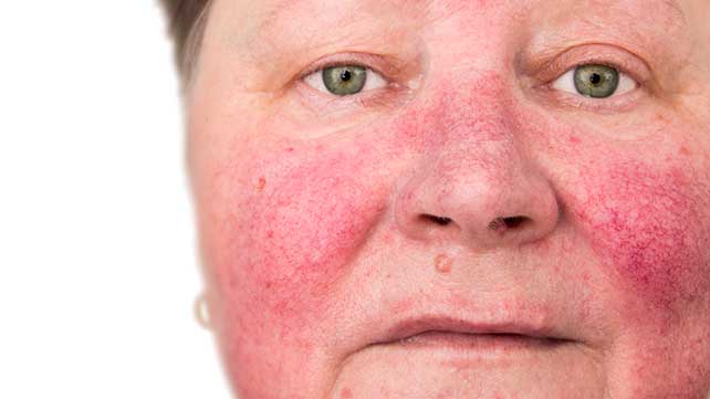 Is a rash a symptom of going through menopause?