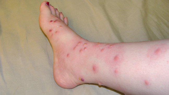 what does poison ivy rash look like
