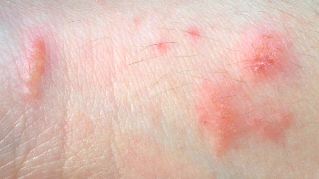 What do poison ivy blisters look like?