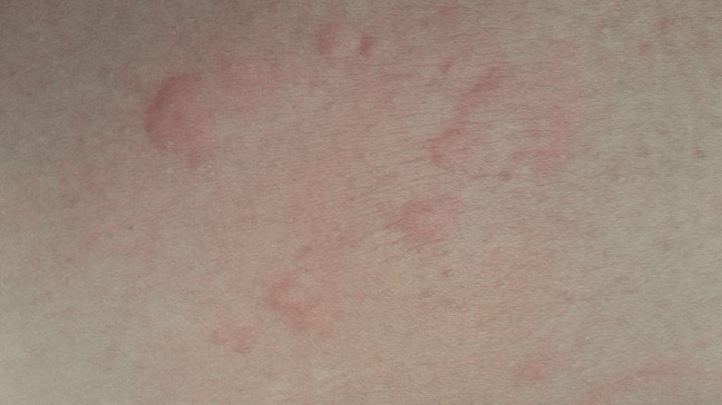 Red Bumps On Legs 60