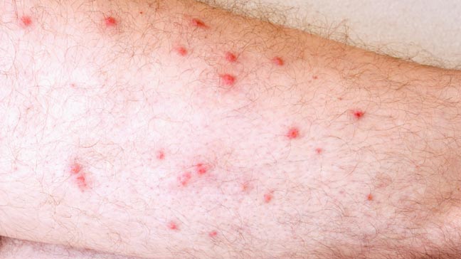 rash on back of leg #10
