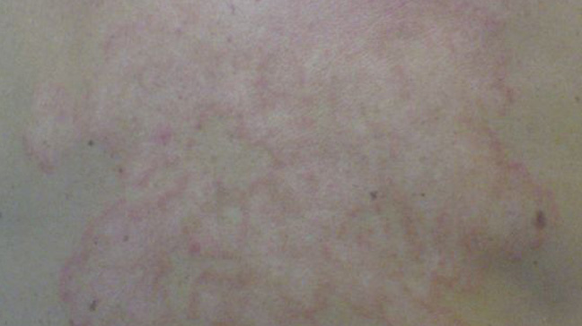 Picture of Ringworm - WebMD