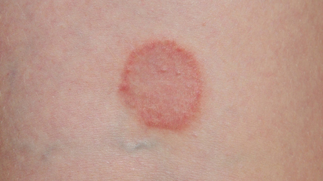 Ringworm Pictures: Rash, Skin Infections, Itching, Home ...