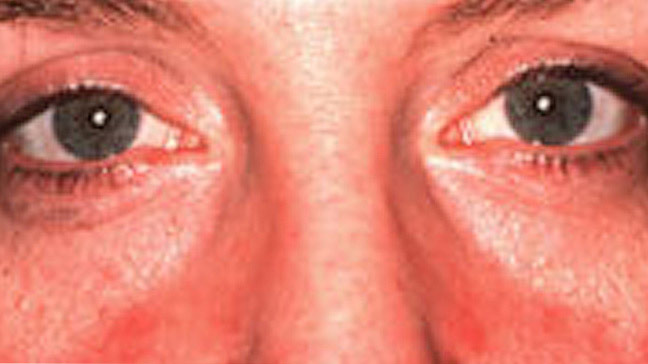 rosacea of the eyes