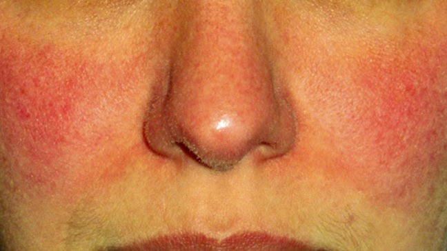 rosacea on nose #10