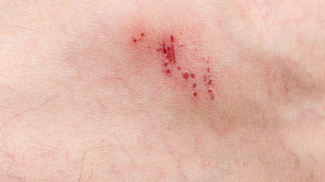 Sebaceous Cyst  Causes  Diagnosis  And Treatment