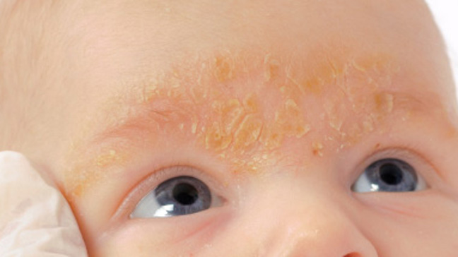 seborrheic dermatitis baby